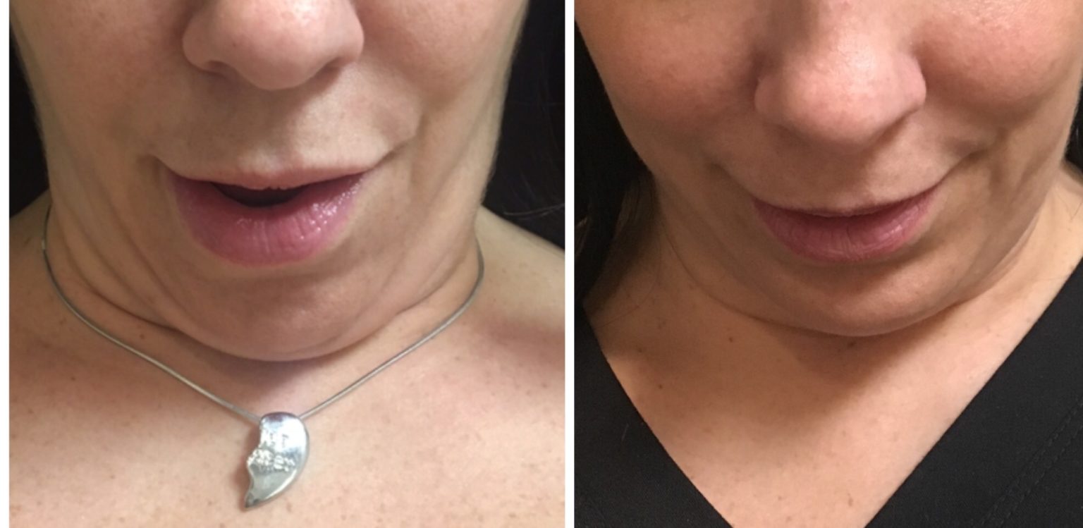 Kybella Double Chin Fat Treatment NJ