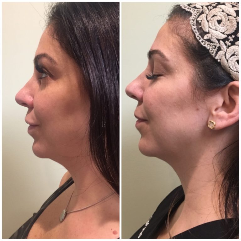 Kybella Double Chin Fat Treatment NJ