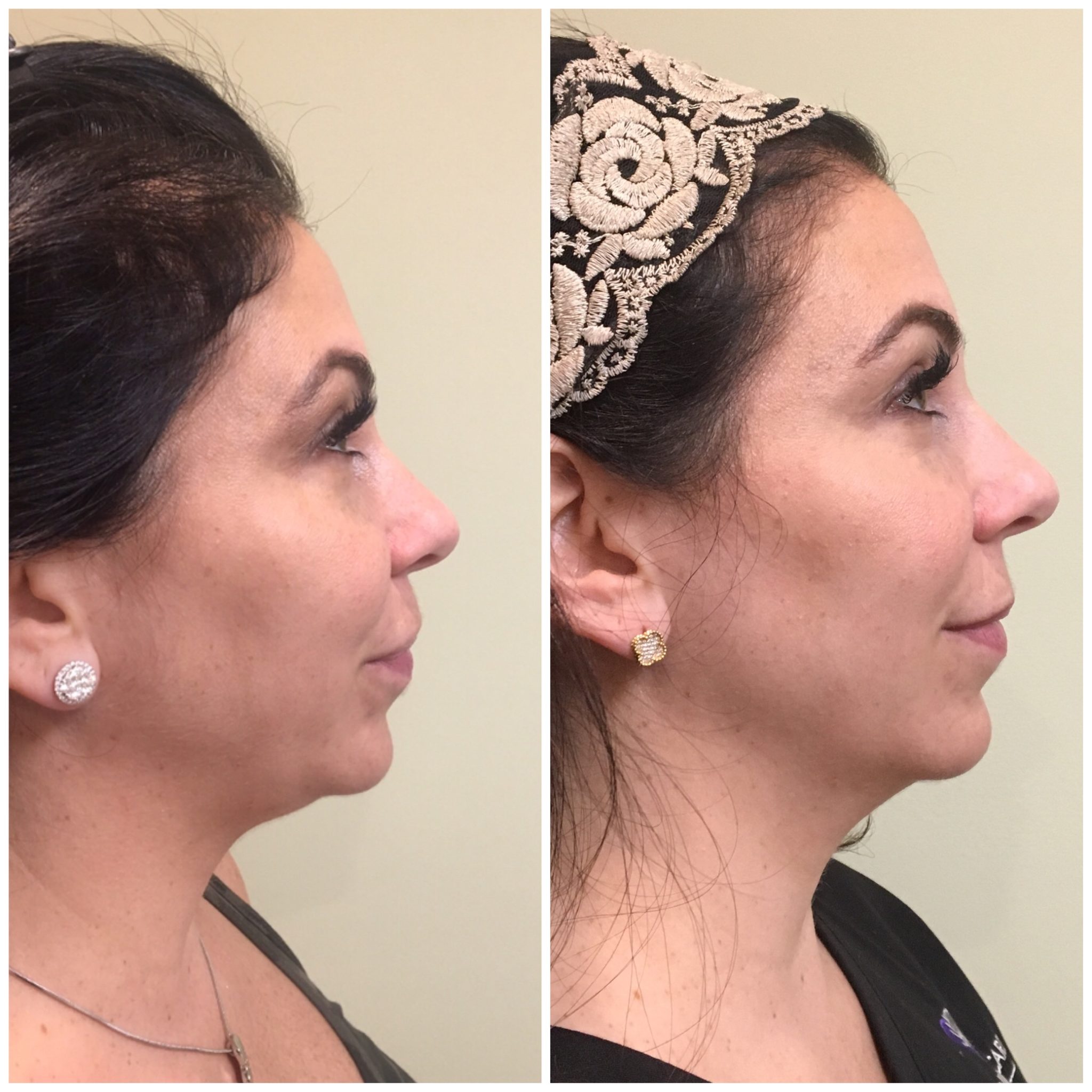 Kybella Double Chin Fat Treatment NJ