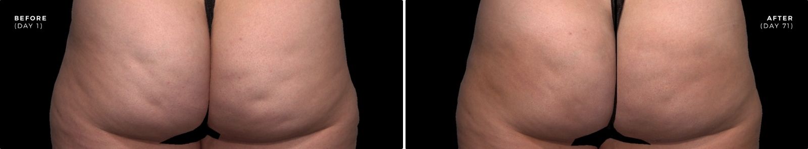 before_and_after_qwo_cellulite_injection_treatment before_and_after_qwo_cellulite_injection_treatment