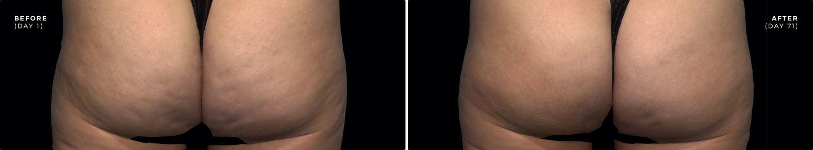 qwo_cellulite_injection_before_and_after_image