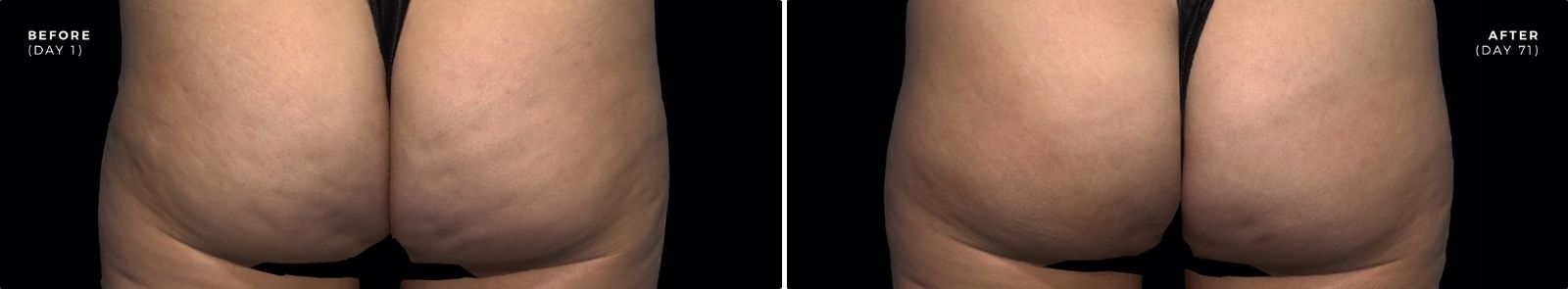 qwo_cellulite_injection_before_and_after_image qwo_cellulite_injection_before_and_after_image