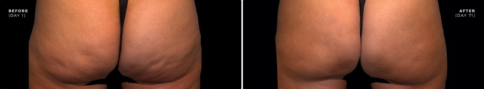 qwo_cellulite_injection_treatment_before_and_after qwo_cellulite_injection_treatment_before_and_after