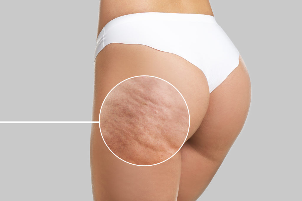 Young,Woman,With,Cellulite,Problem,On,Light,Background Young,Woman,With,Cellulite,Problem,On,Light,Background
